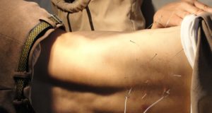 Acupuncture