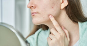 cbd et irritation peau