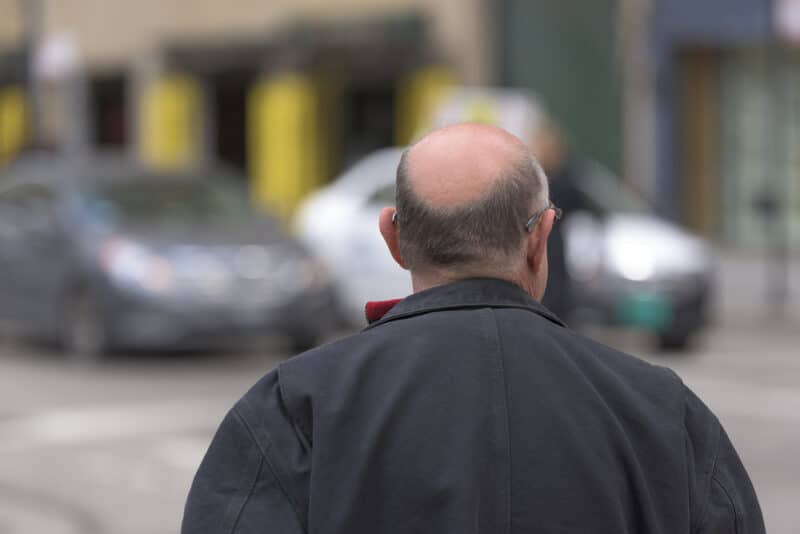 greffe cheveux