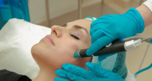microneedling
