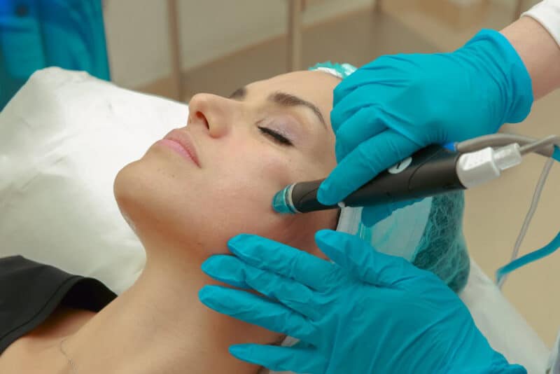 microneedling