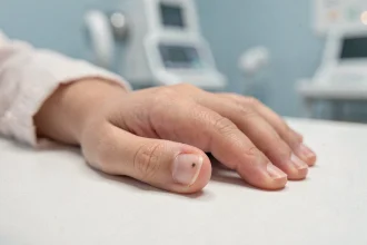 Gros plan sur l'ongle d'un enfant présentant une tache noire sous l'ongle, posé sur une table d'examen médicale